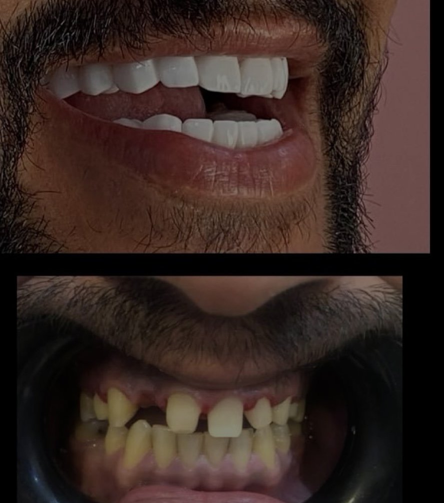 قبل وبعد - حالة تجميل أسنان حقيقية